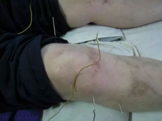 最近看见的脑卒中的康复治疗可靠吗？有效果？